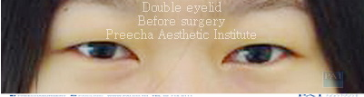 double eyelid beforel Preecha Aesthetic Institute