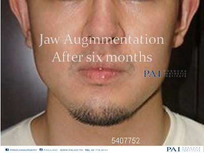 jaw augmentation 6 month after surgery preecha aesthetic institute