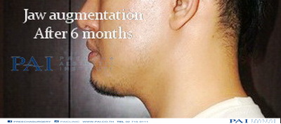 jaw augmentation after 6 month preecha aesthetic institute