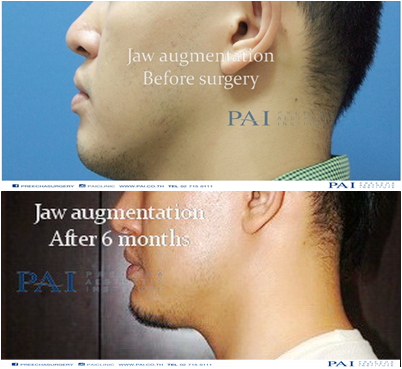 jaw augmentation before after 6 month surgery preecha aesthetic institute