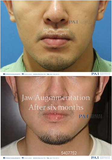 jaw augmentation before and after 6 month surgery preecha aesthetic institute