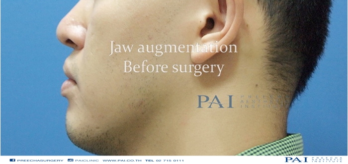 jaw augmentation before surgery preecha aesthetic institute