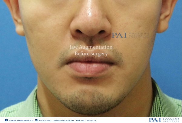 jaw augmentation before surgery preecha aesthetic institute
