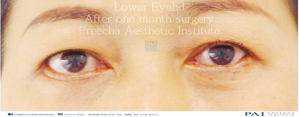 lower blepharoplasty after surgery preecha aesthetic institute