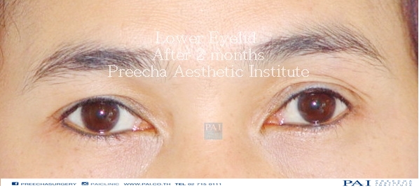 lower blepharoplasty after two month surgery preecha aesthetic inst bangkok