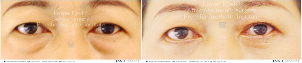 lower blepharoplasty before and after surgery preecha aesthetic institute