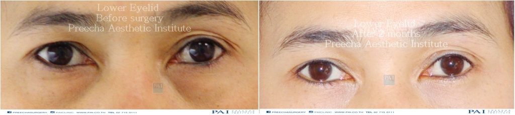 lower blepharoplasty before and after two months surgery preecha aesthetic inst bangkok