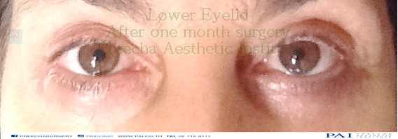 lower eyelid after one month surgery preecha aesthetic institute