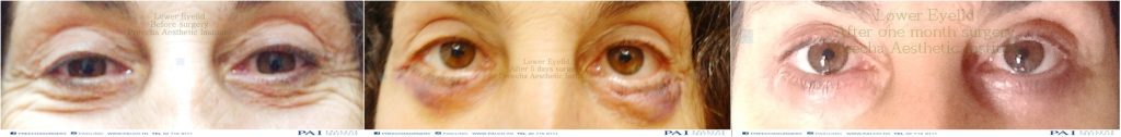 lower eyelid before and after surgery preecha aesthetic institute