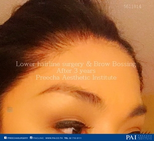 lower hairline and brow bossing surgery facial feminization surgery (FFS) after surgery preecha aesthetic institute Bangkok thailand