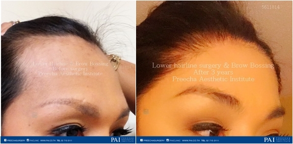 lower hairline and brow bossing surgery facial feminization surgery (FFS) before and after surgery preecha aesthetic institute Bangkok thailand