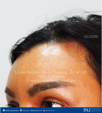 lower hairline, brow bossing, brow lift facial feminization surgery (MtF) after surgery