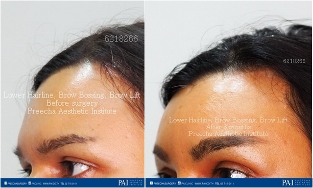 lower hairline, brow bossing, brow lift facial feminization surgery (MtF) before and after surgery