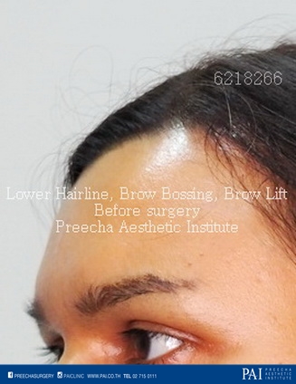 lower hairline, brow bossing, brow lift facial feminization surgery (MtF) before surgery