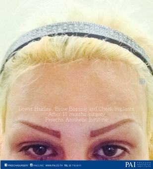 lower hairline, brow bossing, cheek augmentation facial feminization surgery after surgery (FFS)