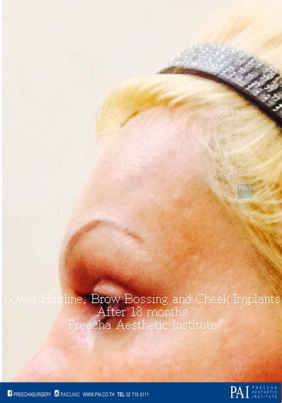 lower hairline, brow bossing, cheek augmentation facial feminization surgery after surgery