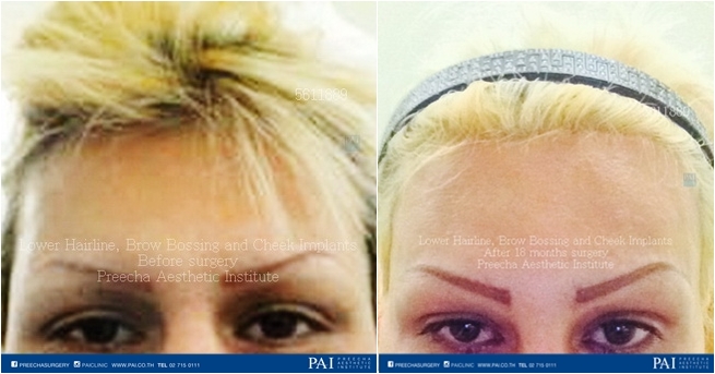 lower hairline, brow bossing, cheek augmentation facial feminization surgery before and after surgery (FFS)