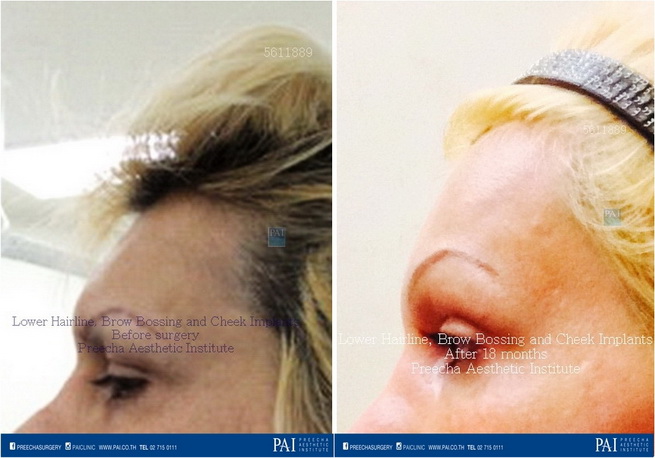 lower hairline, brow bossing, cheek augmentation facial feminization surgery before and after surgery