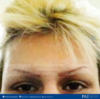 lower hairline, brow bossing, cheek augmentation facial feminization surgery before surgery (FFS)