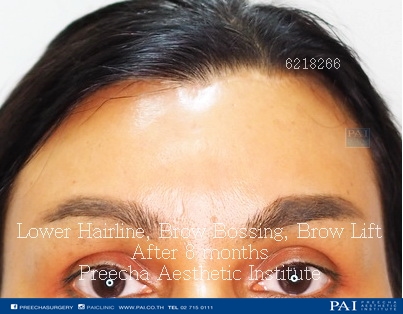 lower hairline brow lift brow bossing (FFS) after surgery
