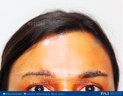 lower hairline brow lift brow bossing (FFS) before surgery