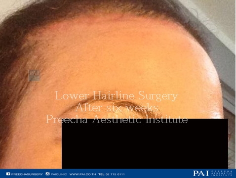lower hairline for Facial feminization surgery after surgery
