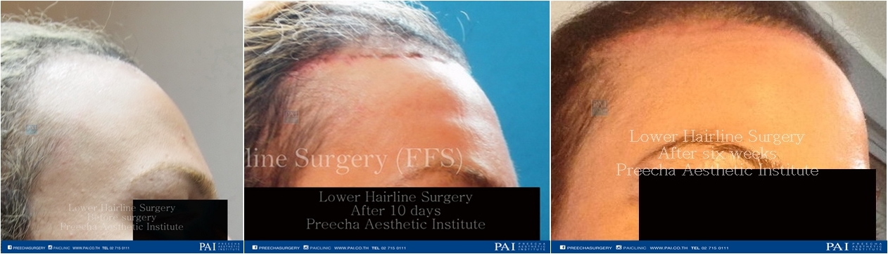 lower hairline for Facial feminization surgery before and after surgery
