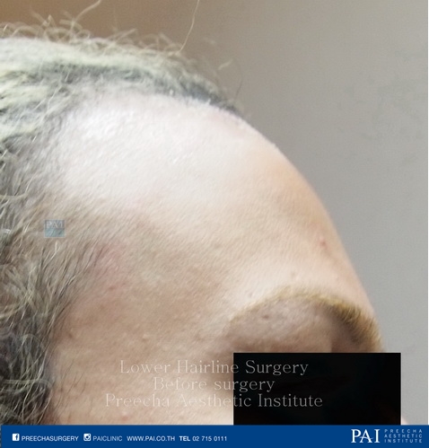 lower hairline for Facial feminization surgery before surgery