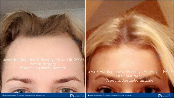 lower hairline surgery facial feminization surgery (FFS) before and after surgery preecha aesthetic institute bangkok