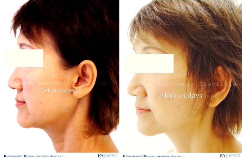 mini facelift before and after 10 days surgery preecha aesthetic institute