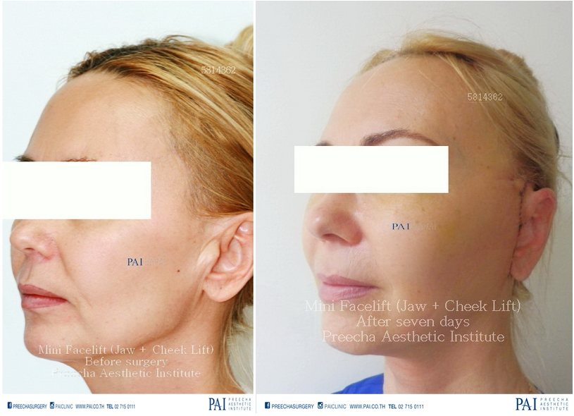 mini facelift smas technique before and after surgery l preecha aesthetic institute