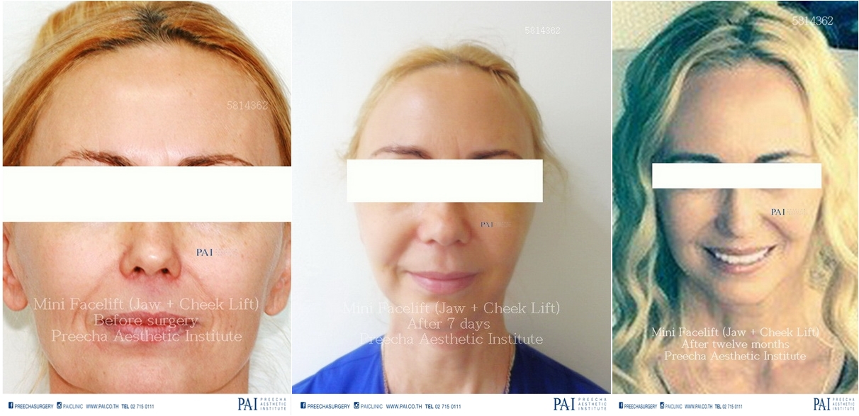 mini facelift smas technique before and after surgery