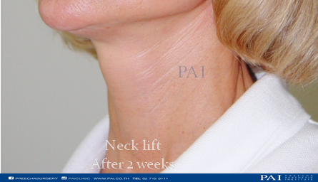 neck after surgery pai clinic thailand