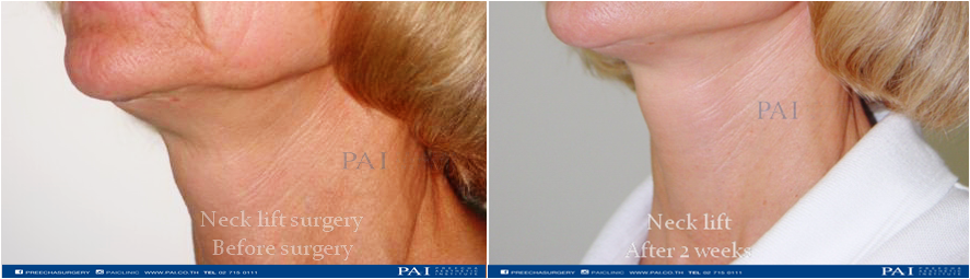 neck before and after two weeks surgery preecha aesthetic institute horz