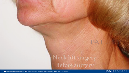 neck before surgery preecha aesthetic institute