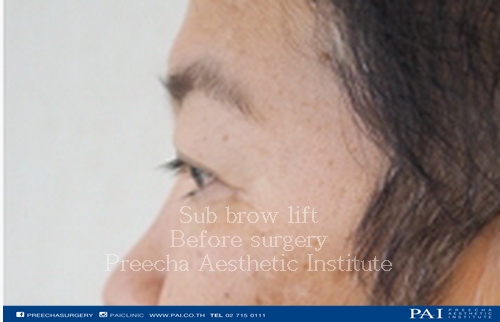 sub brow lift before surgery