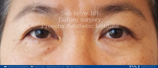 sub brow lift before surgery
