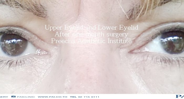 upper and lower eyelid after one month surgery preecha aesthetic institute
