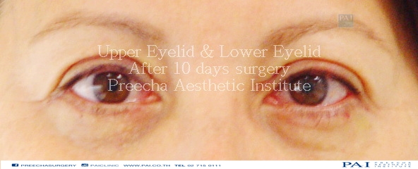 upper and lower eyelid after ten days