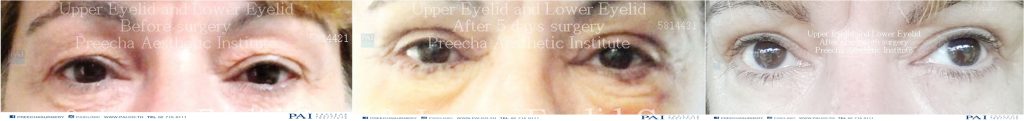 upper and lower eyelid before and after surgery preecha aesthetic institute