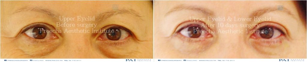 upper and lower eyelid before and after ten days surgery