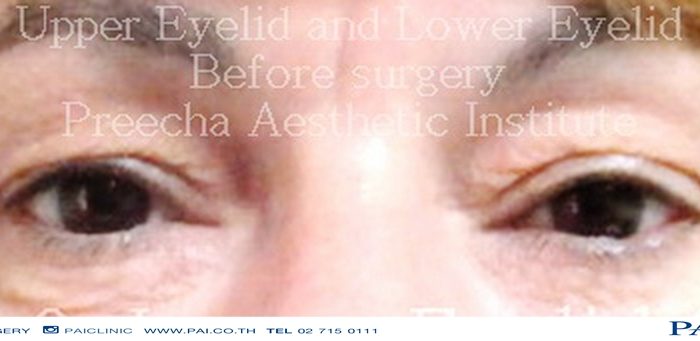 upper and lower eyelid before surgery preecha aesthetic institute
