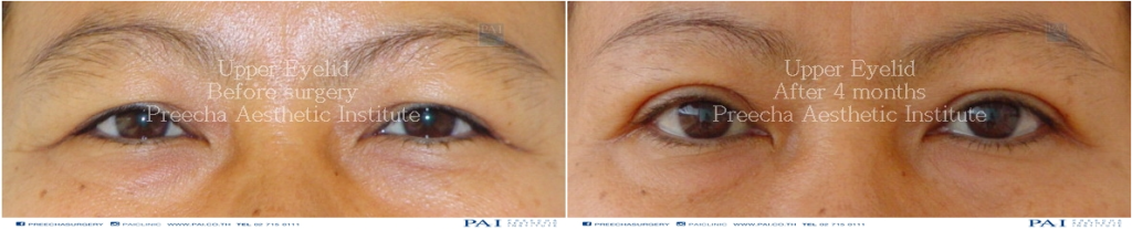upper blepharoplasty before and after surgery