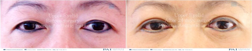 upper eyelid before and after surgery l Preecha Aesthetic Institute