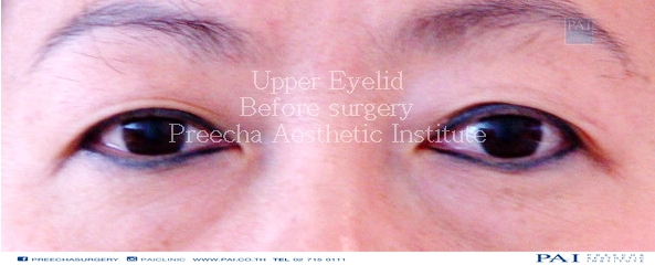 upper eyelid before surgery l Preecha Aesthetic Institute