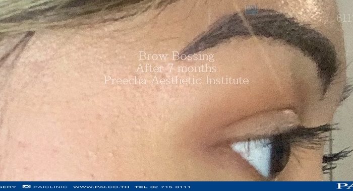 Brow bossing after seven months surgery at preecha aesthetic institute bangkok thailand dr.sutin, dr.burin, dr.preecha