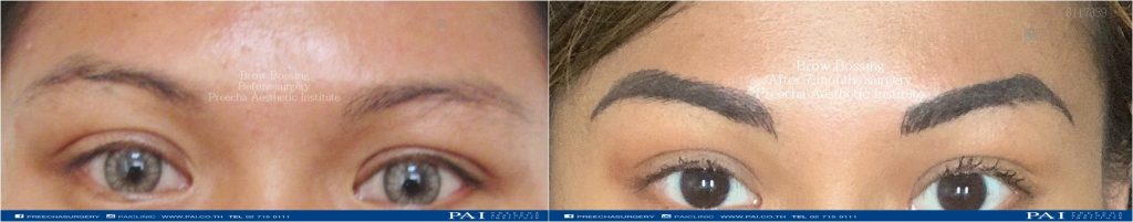 Brow bossing before and after surgery at preecha aesthetic institute bangkok thailand dr.sutin, dr.burin, dr.preecha