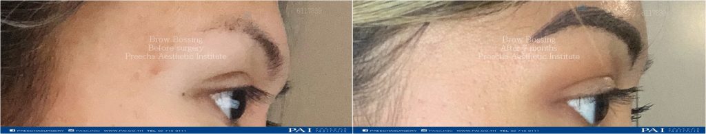 Brow bossing before and after surgery at preecha aesthetic institute bangkok thailand dr.sutin, dr.burin, dr.preecha tiewtranon md
