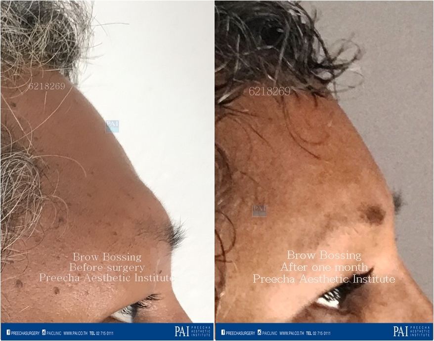 Brow bossing facial feminization surgery by preecha aesthetic institute before and after surgery