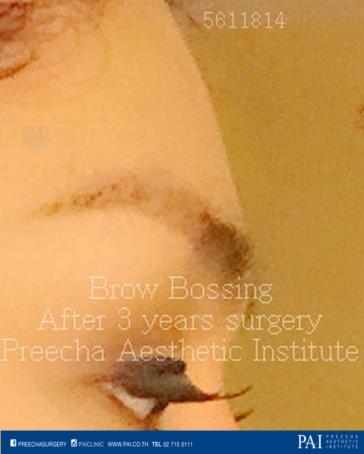 brow bossing after surgery best cosmetic and facial feminization surgery bangkok thailand Preecha Aesthetic